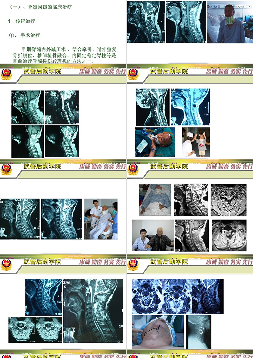 2023年脊髓損傷研究新進展,里程碑式的突破與日常奇妙變化