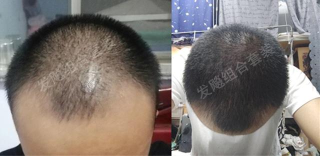 治愈脫發最新重大突破，重塑自信，希望之光再現