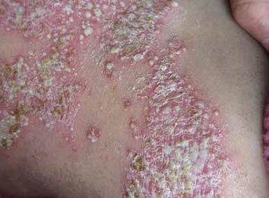 最新牛皮癬治療方法概覽