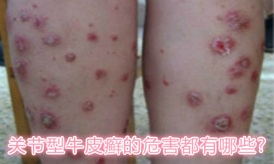 最新牛皮癬治療方法概覽