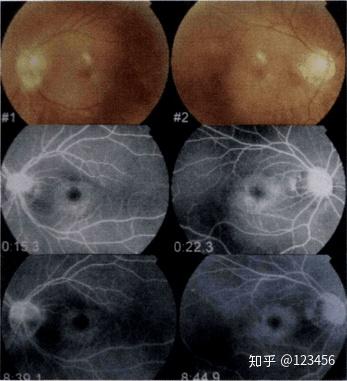 最新藥肺炎詳解,你需要知道的一切——健康小紅書